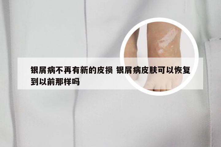银屑病不再有新的皮损 银屑病皮肤可以恢复到以前那样吗