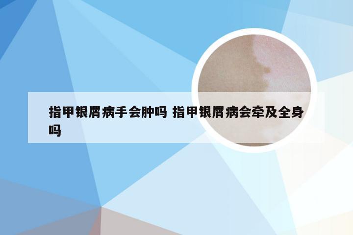 指甲银屑病手会肿吗 指甲银屑病会牵及全身吗