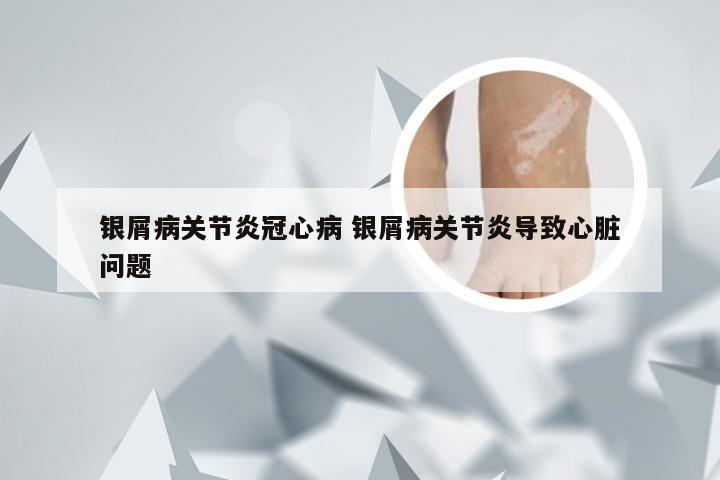 银屑病关节炎冠心病 银屑病关节炎导致心脏问题