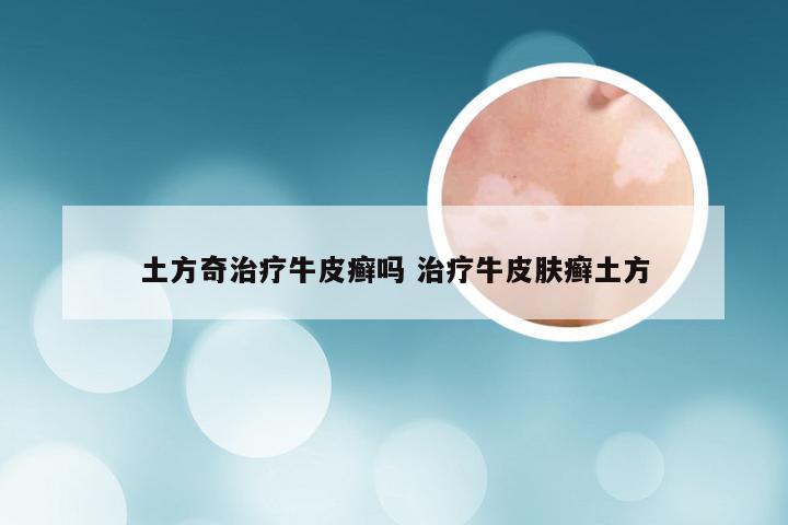 土方奇治疗牛皮癣吗 治疗牛皮肤癣土方