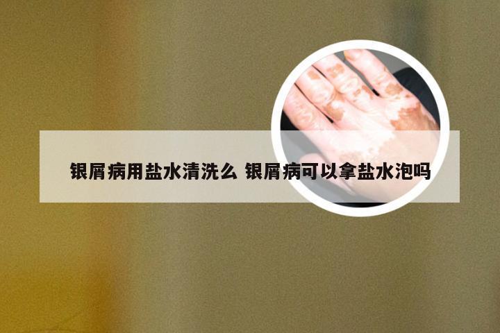 银屑病用盐水清洗么 银屑病可以拿盐水泡吗