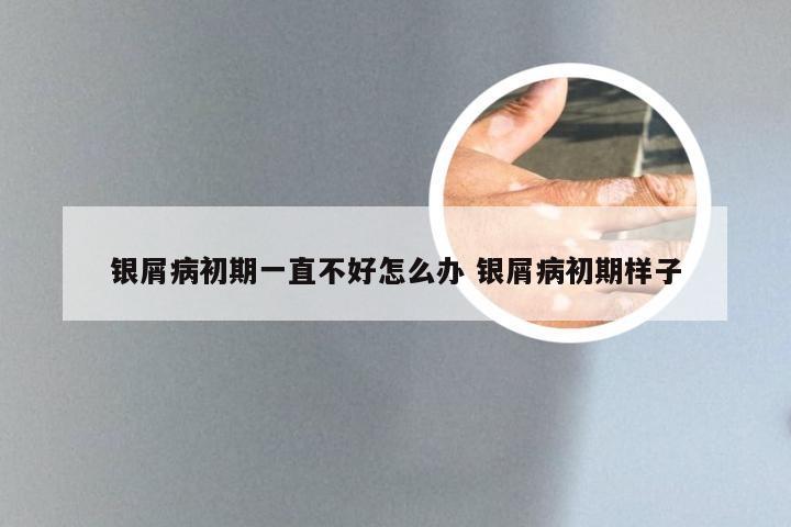 银屑病初期一直不好怎么办 银屑病初期样子