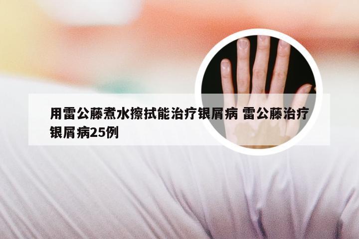 用雷公藤煮水擦拭能治疗银屑病 雷公藤治疗银屑病25例