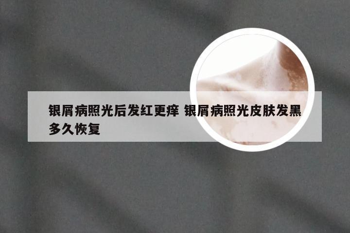 银屑病照光后发红更痒 银屑病照光皮肤发黑多久恢复