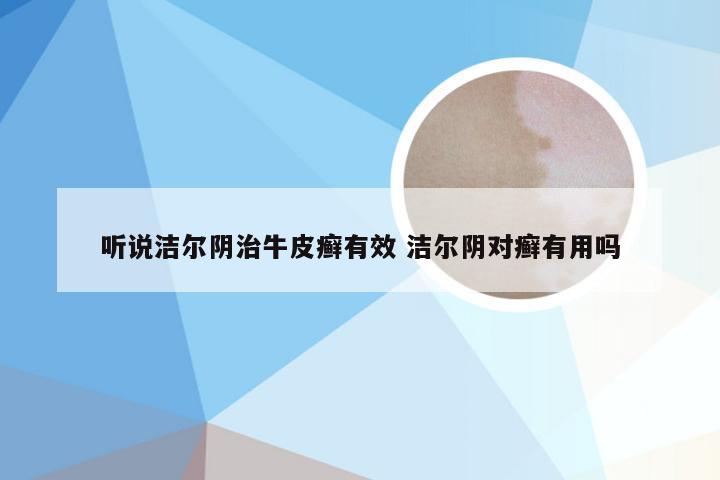 听说洁尔阴治牛皮癣有效 洁尔阴对癣有用吗