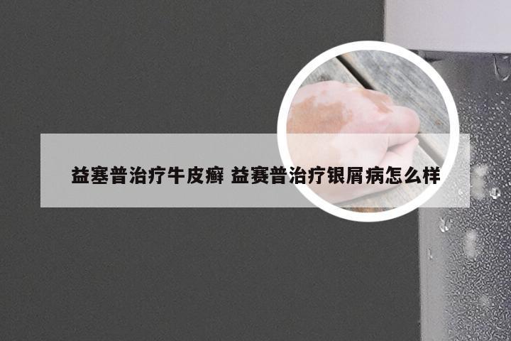 益塞普治疗牛皮癣 益赛普治疗银屑病怎么样