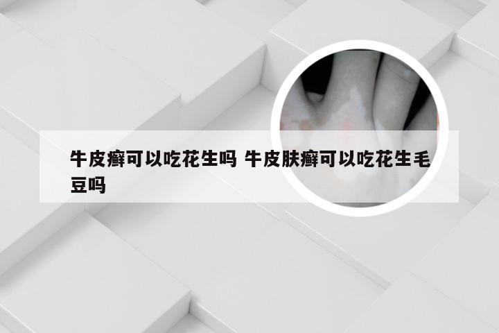 牛皮癣可以吃花生吗 牛皮肤癣可以吃花生毛豆吗