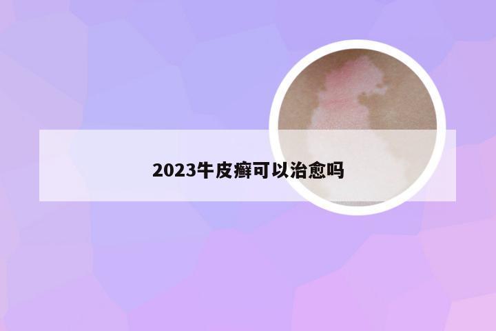 2023牛皮癣可以治愈吗