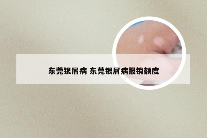 东莞银屑病 东莞银屑病报销额度