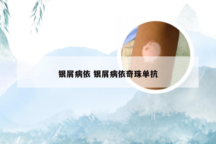 银屑病依 银屑病依奇珠单抗
