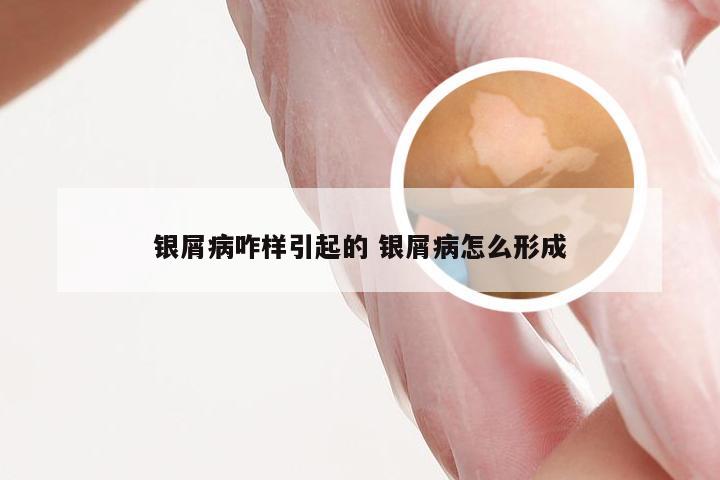 银屑病咋样引起的 银屑病怎么形成