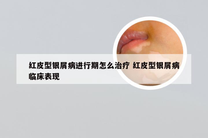 红皮型银屑病进行期怎么治疗 红皮型银屑病临床表现