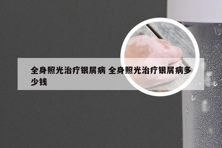 全身照光治疗银屑病 全身照光治疗银屑病多少钱