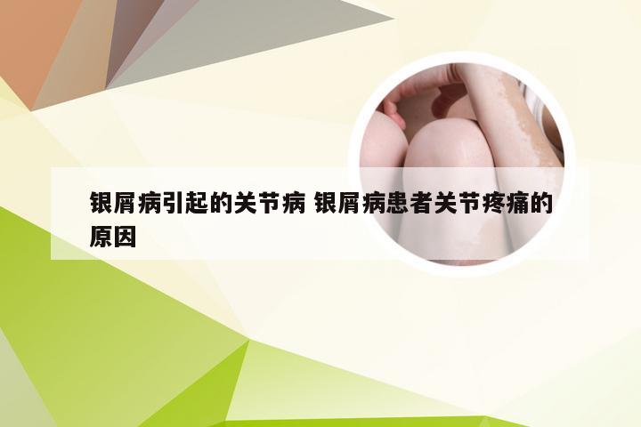 银屑病引起的关节病 银屑病患者关节疼痛的原因