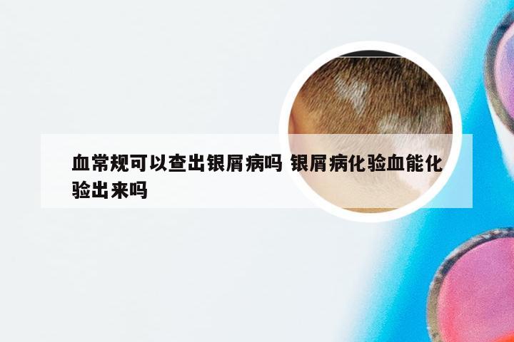 血常规可以查出银屑病吗 银屑病化验血能化验出来吗