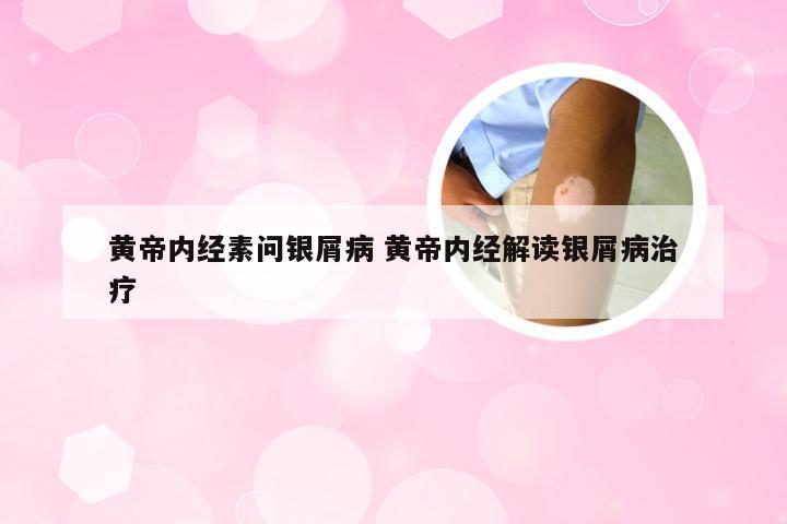 黄帝内经素问银屑病 黄帝内经解读银屑病治疗