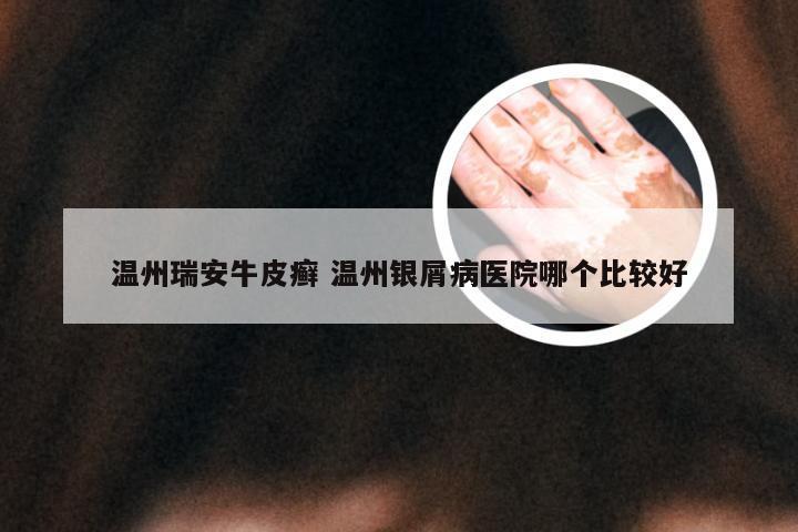 温州瑞安牛皮癣 温州银屑病医院哪个比较好