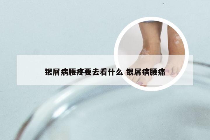 银屑病腰疼要去看什么 银屑病腰痛