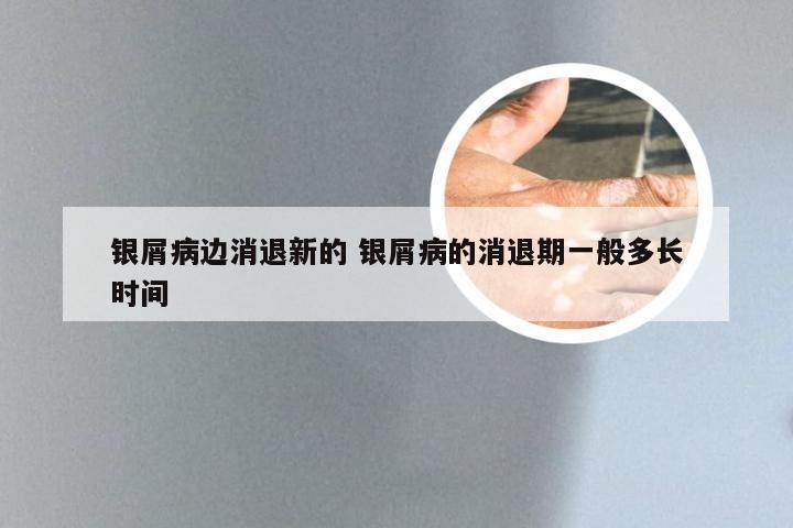 银屑病边消退新的 银屑病的消退期一般多长时间