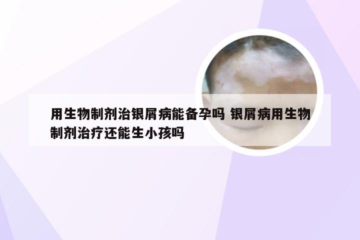用生物制剂治银屑病能备孕吗 银屑病用生物制剂治疗还能生小孩吗