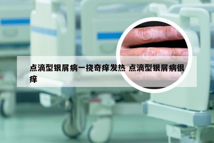 点滴型银屑病一挠奇痒发热 点滴型银屑病很痒