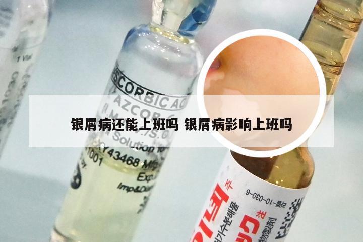 银屑病还能上班吗 银屑病影响上班吗