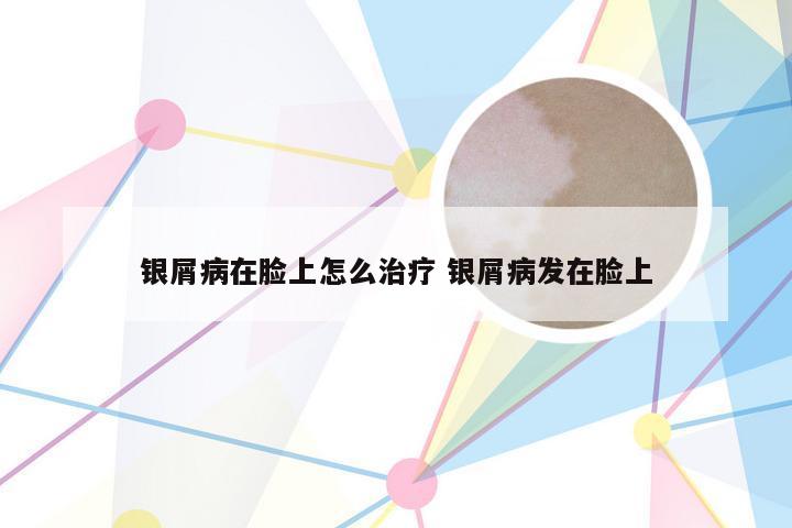 银屑病在脸上怎么治疗 银屑病发在脸上