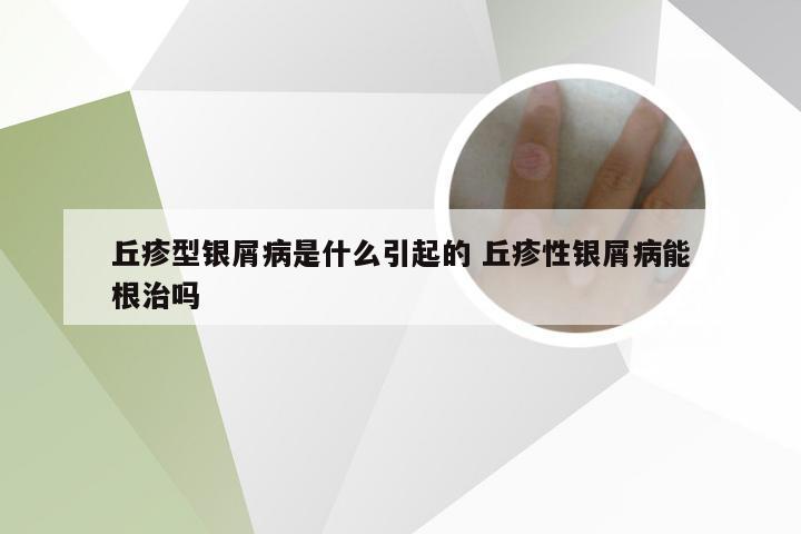 丘疹型银屑病是什么引起的 丘疹性银屑病能根治吗