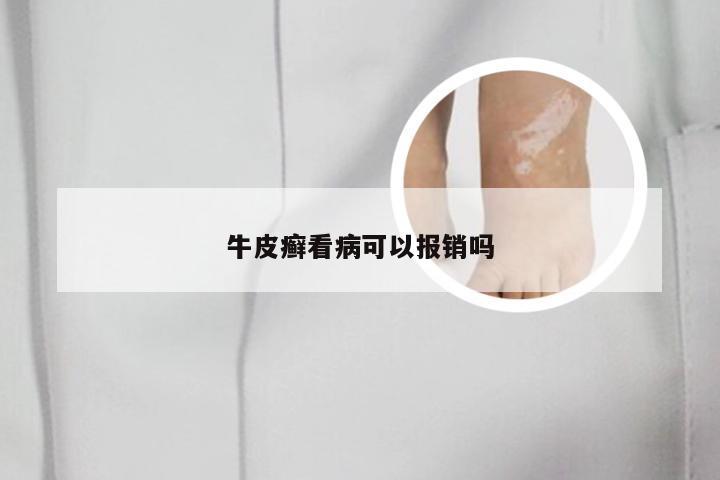 牛皮癣看病可以报销吗