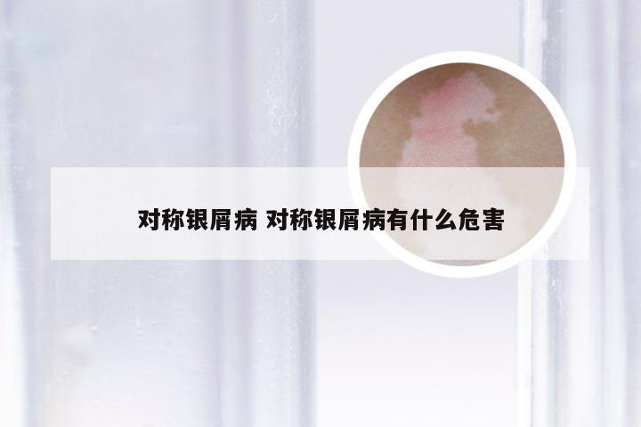 对称银屑病 对称银屑病有什么危害