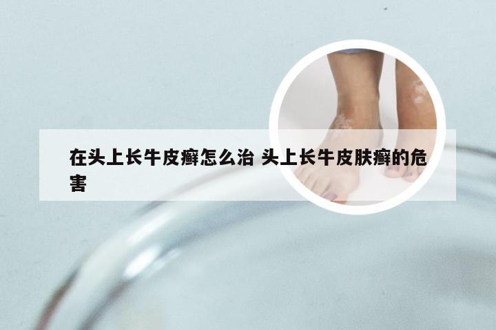 在头上长牛皮癣怎么治 头上长牛皮肤癣的危害
