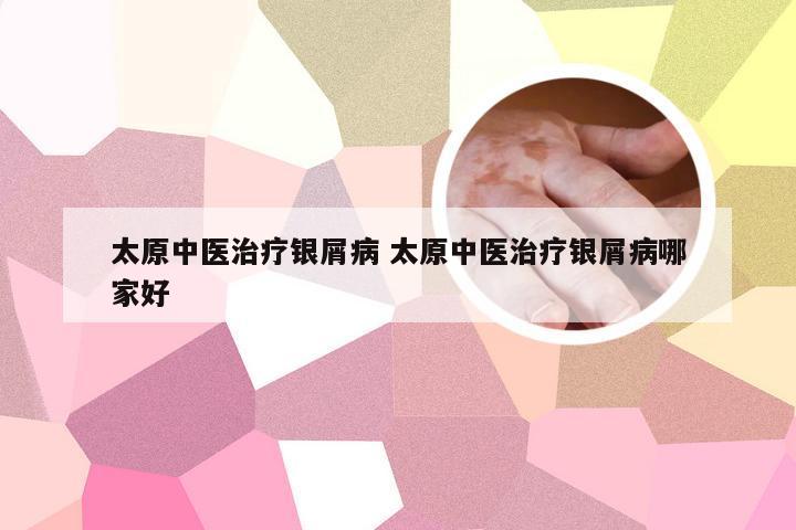 太原中医治疗银屑病 太原中医治疗银屑病哪家好