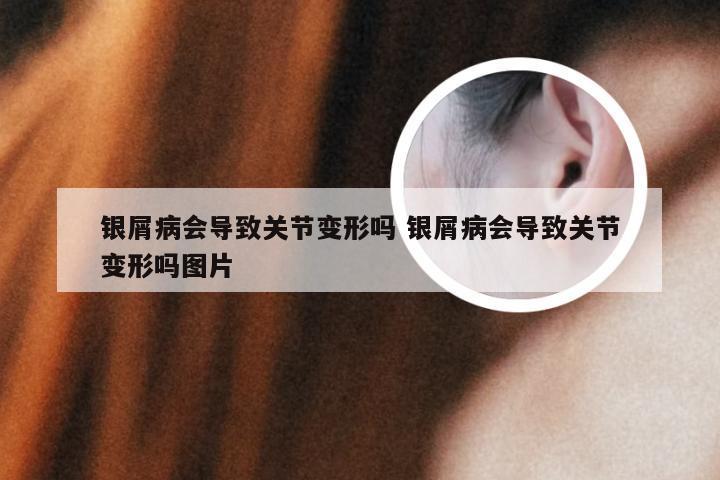 银屑病会导致关节变形吗 银屑病会导致关节变形吗图片
