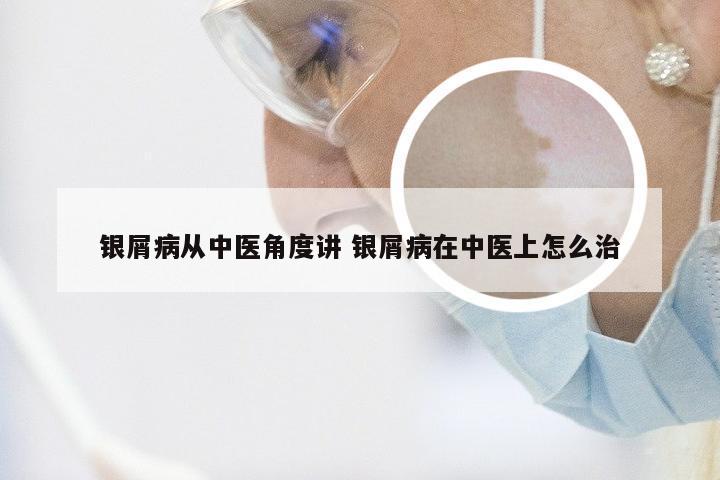 银屑病从中医角度讲 银屑病在中医上怎么治
