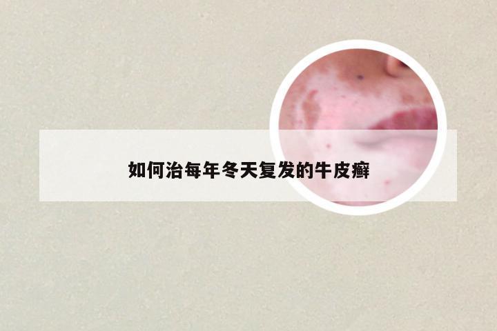 如何治每年冬天复发的牛皮癣