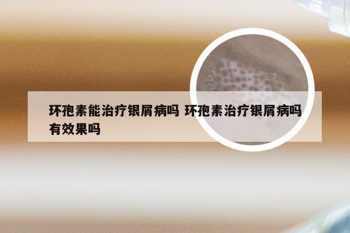 环孢素能治疗银屑病吗 环孢素治疗银屑病吗有效果吗