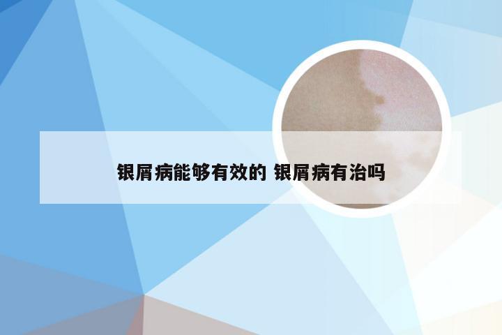 银屑病能够有效的 银屑病有治吗