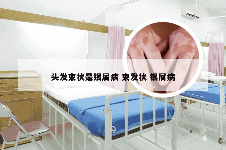 头发束状是银屑病 束发状 银屑病