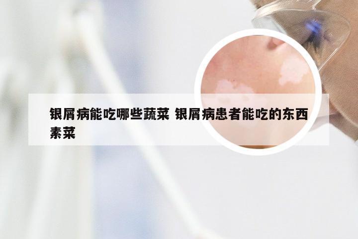 银屑病能吃哪些蔬菜 银屑病患者能吃的东西素菜