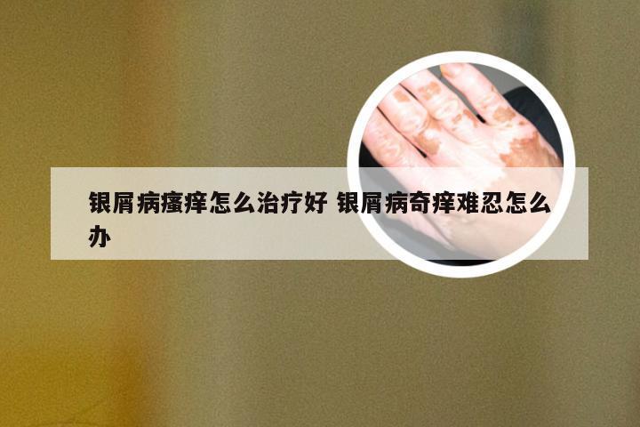 银屑病瘙痒怎么治疗好 银屑病奇痒难忍怎么办