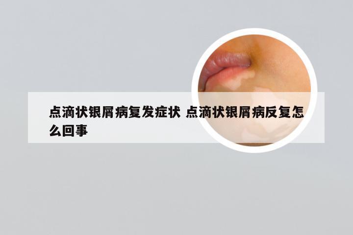 点滴状银屑病复发症状 点滴状银屑病反复怎么回事