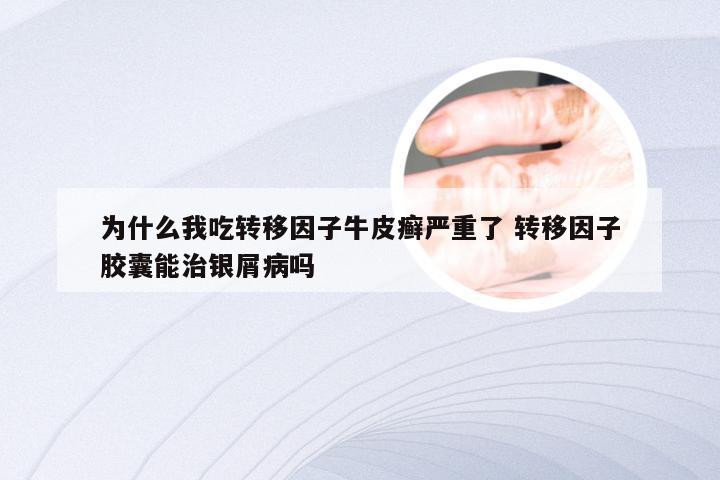 为什么我吃转移因子牛皮癣严重了 转移因子胶囊能治银屑病吗
