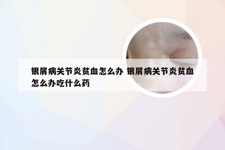 银屑病关节炎贫血怎么办 银屑病关节炎贫血怎么办吃什么药