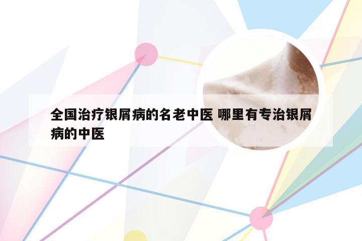 全国治疗银屑病的名老中医 哪里有专治银屑病的中医