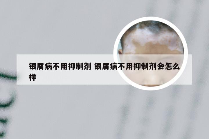 银屑病不用抑制剂 银屑病不用抑制剂会怎么样