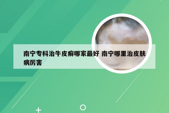 南宁专科治牛皮癣哪家最好 南宁哪里治皮肤病厉害