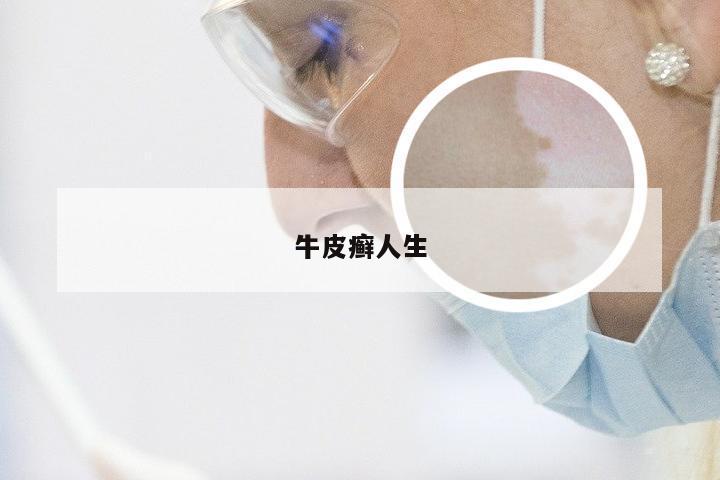 牛皮癣人生