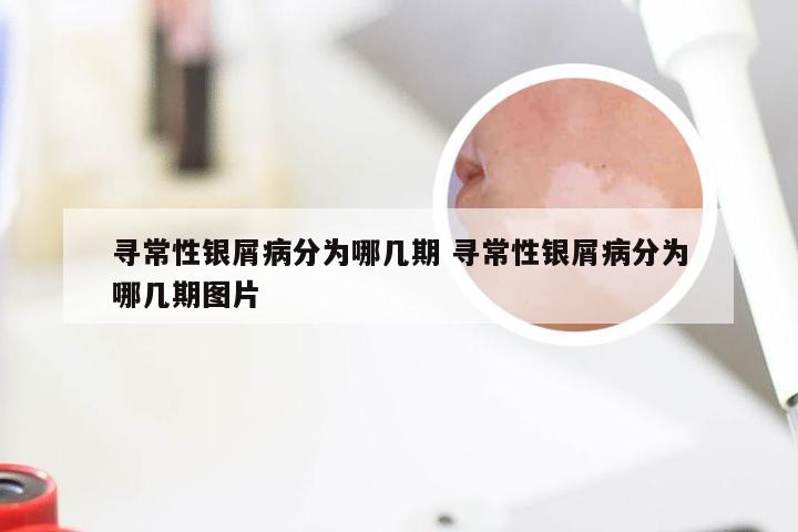 寻常性银屑病分为哪几期 寻常性银屑病分为哪几期图片