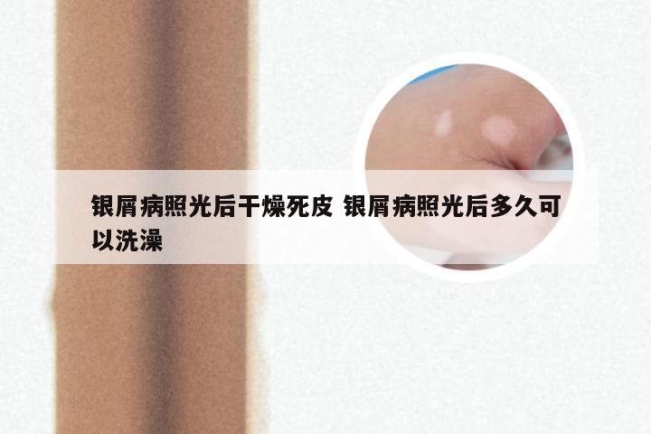银屑病照光后干燥死皮 银屑病照光后多久可以洗澡