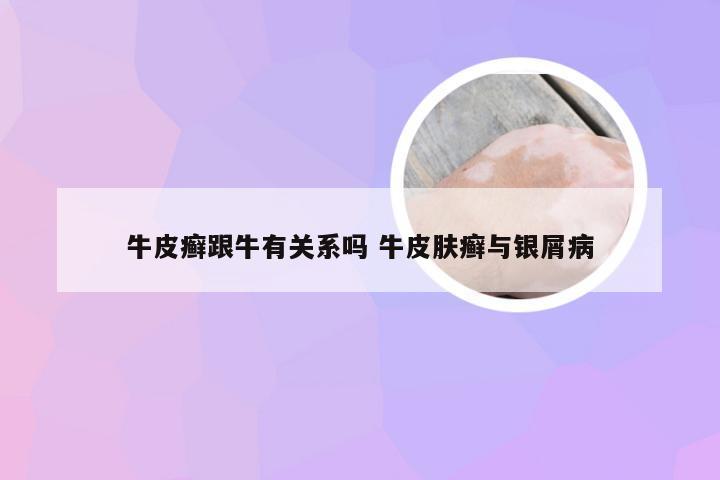 牛皮癣跟牛有关系吗 牛皮肤癣与银屑病